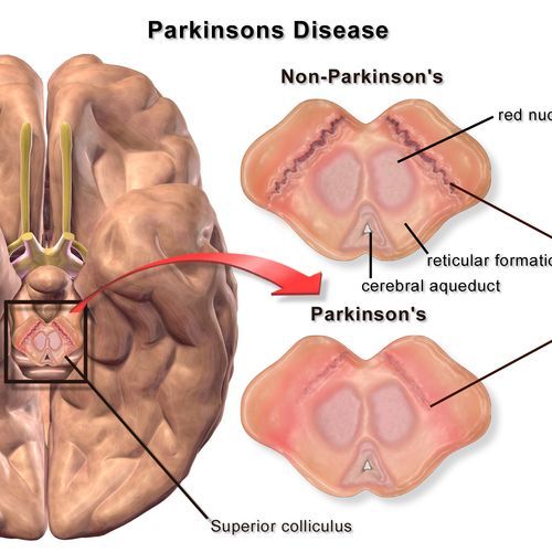 Parkinson’s walking football initiative relaunched in Sheffield