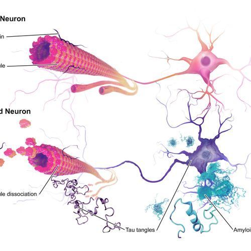 HIV Pills Might Prevent Alzheimer's