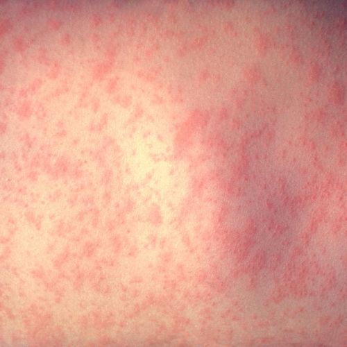 Lubbock experts advise against home remedies as a solution to the measles